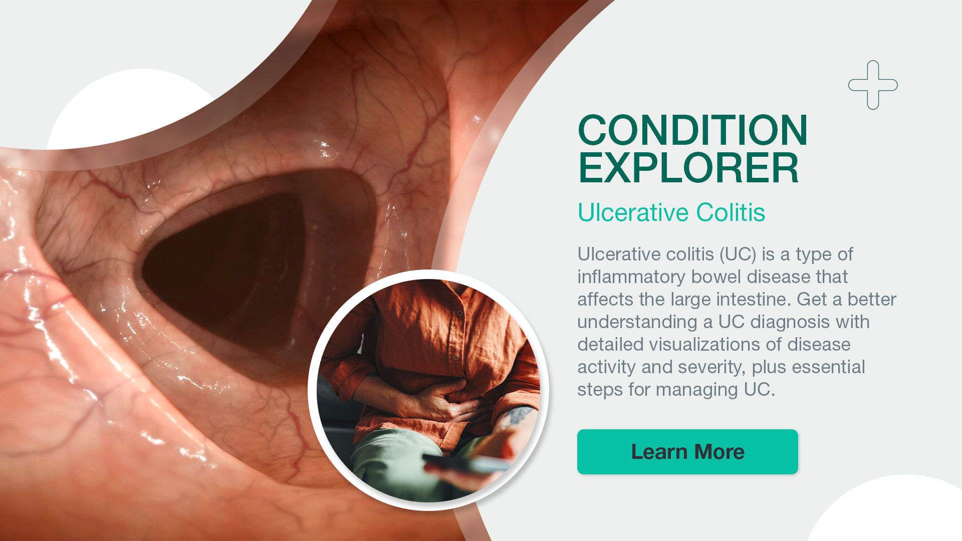 Condition Explorer: Ulcerative Colitis