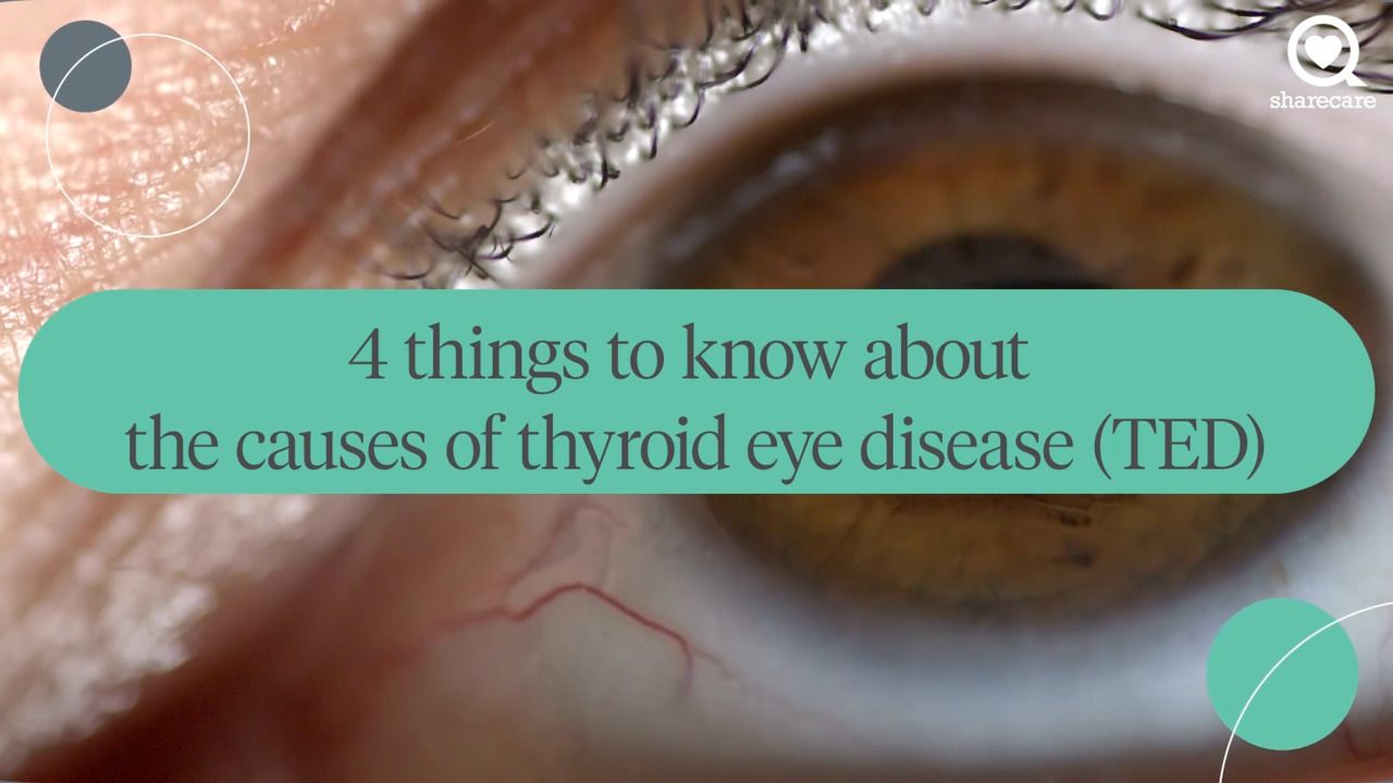 4 things to know about the causes of thyroid eye disease (TED)