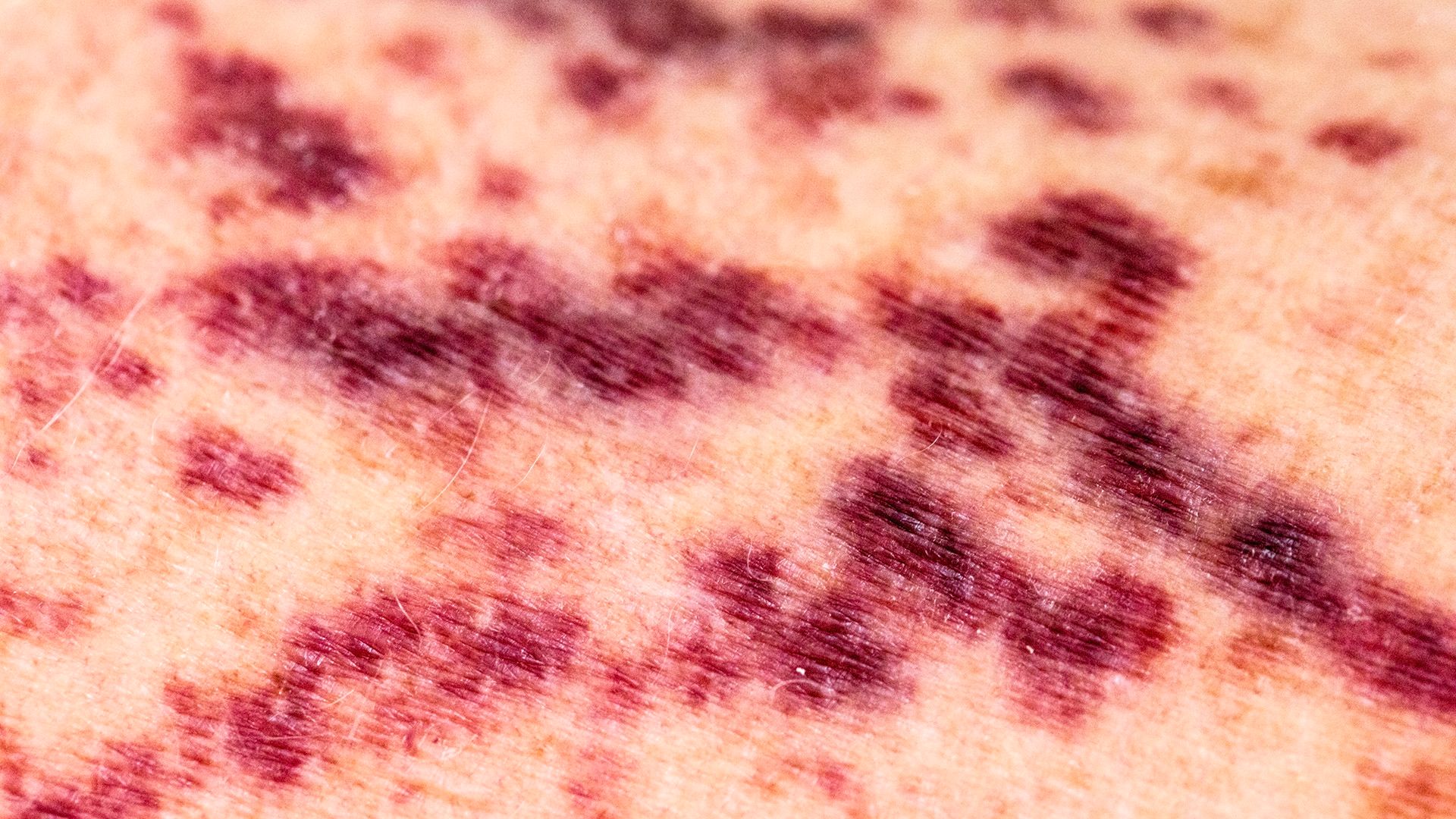 Why ITP causes bleeding and bruising symptoms