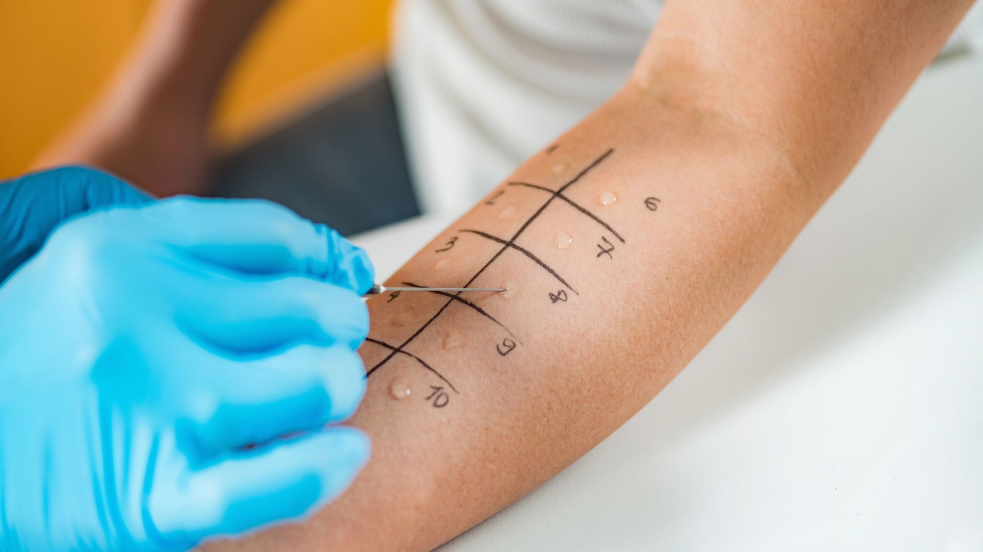 5 answers about adult-onset food allergies