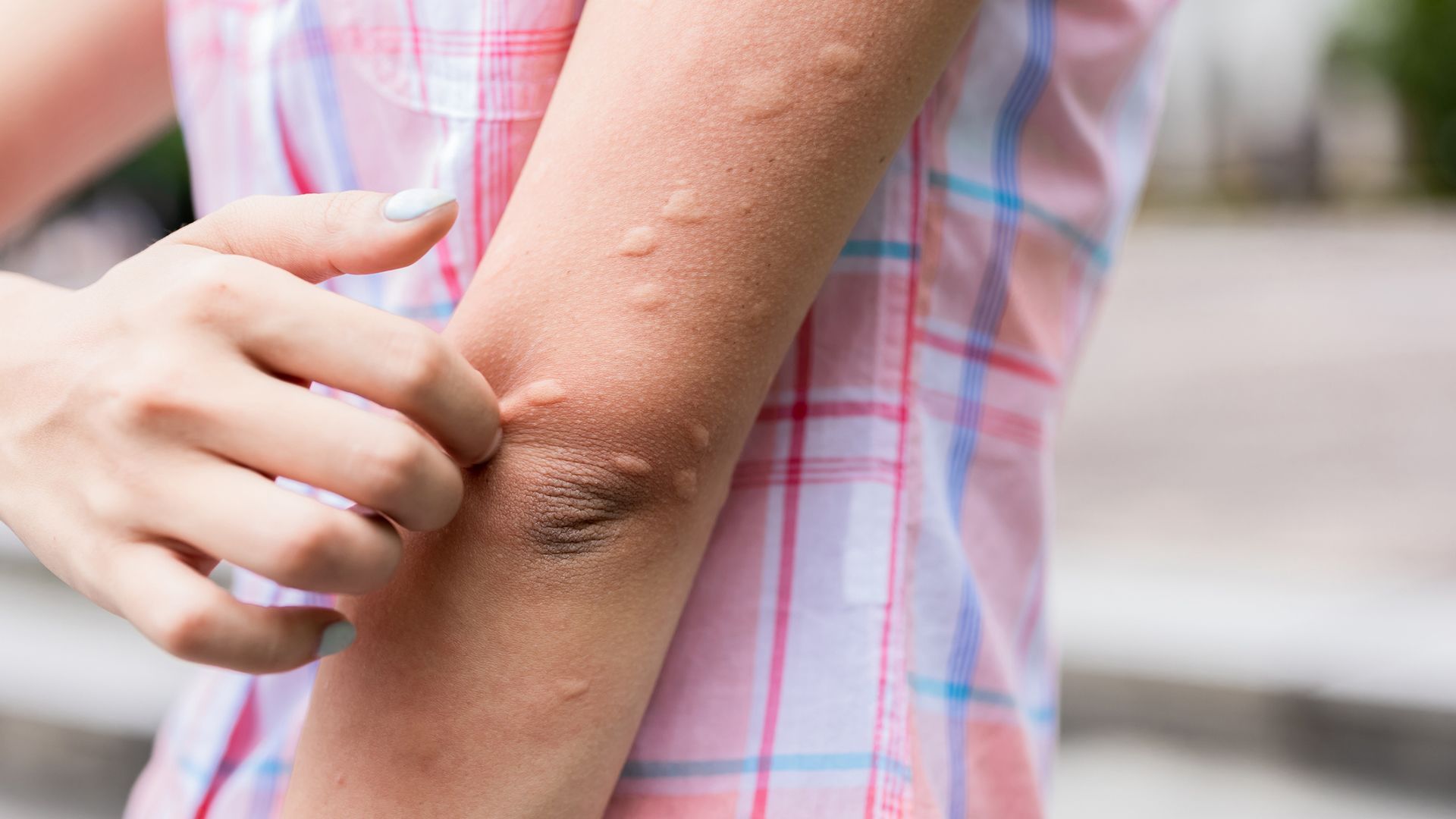 Is chronic spontaneous urticaria an autoimmune disease?