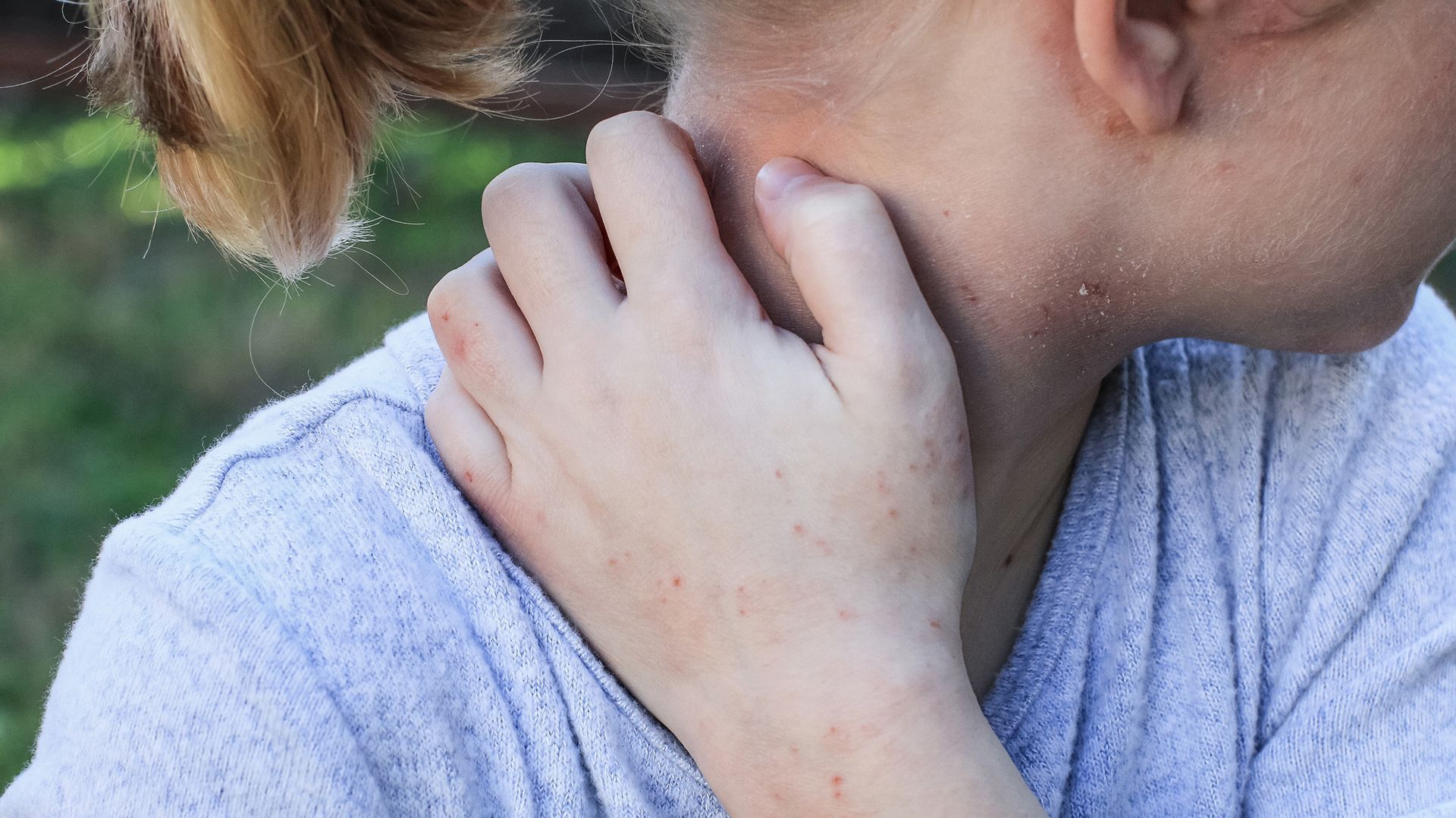 What types of psoriasis are common in children?