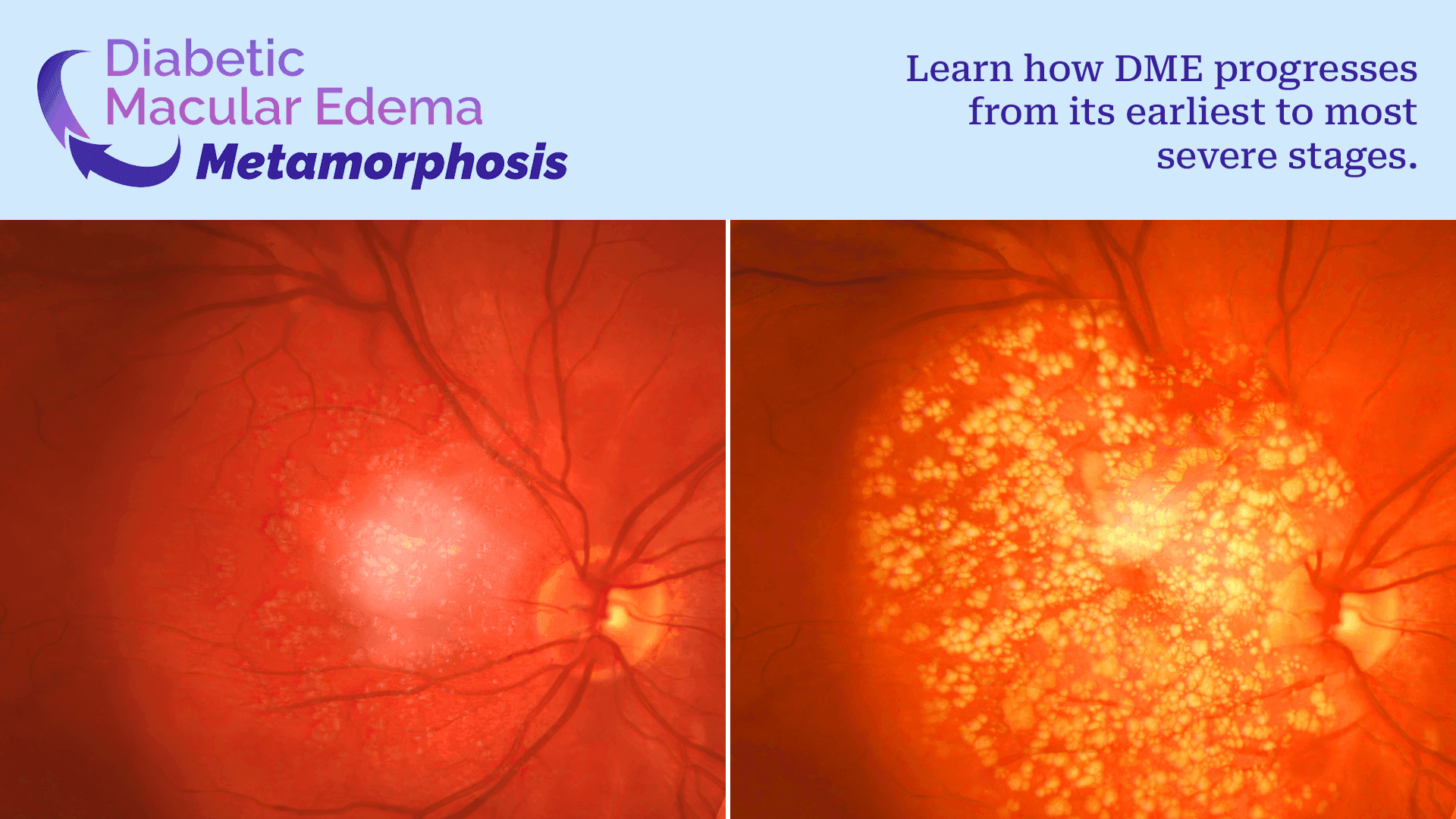 Condition Metamorphosis: DME