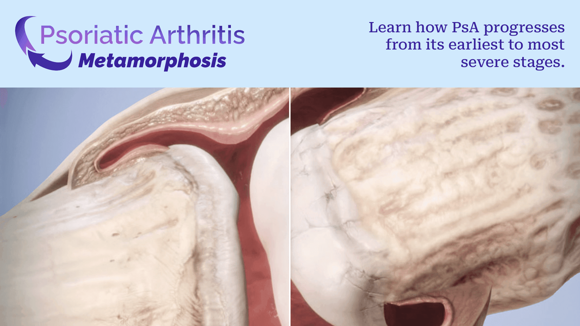 Condition Metamorphosis: PsA