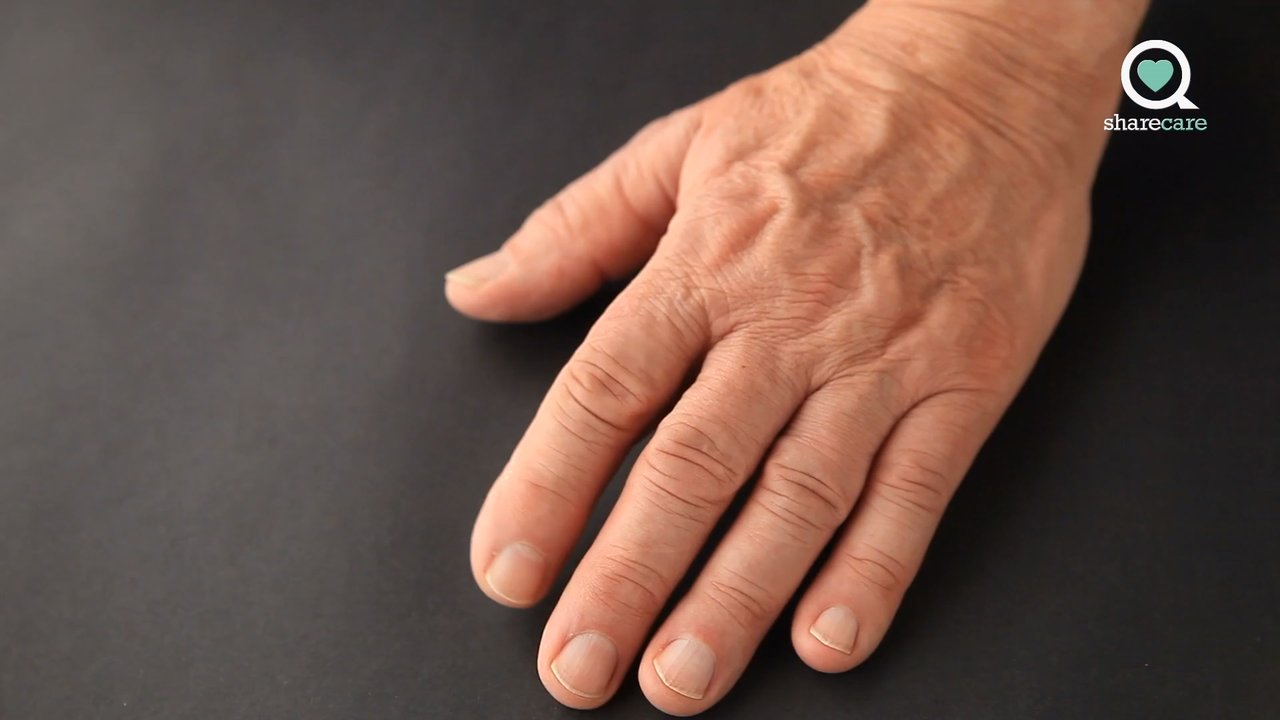 What are the symptoms of TD?