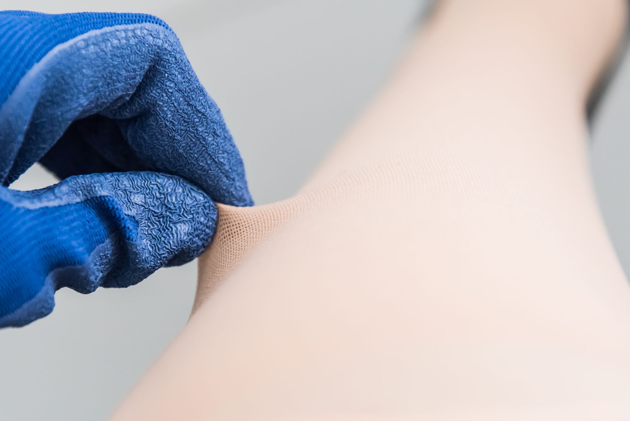 5 answers about Graves' disease and thyroid dermopathy