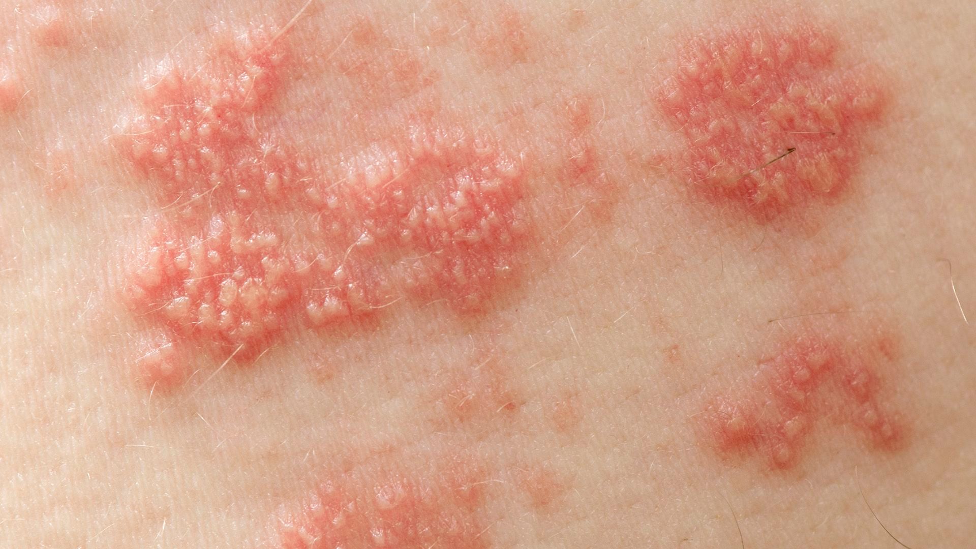 How long can a shingles rash last?
