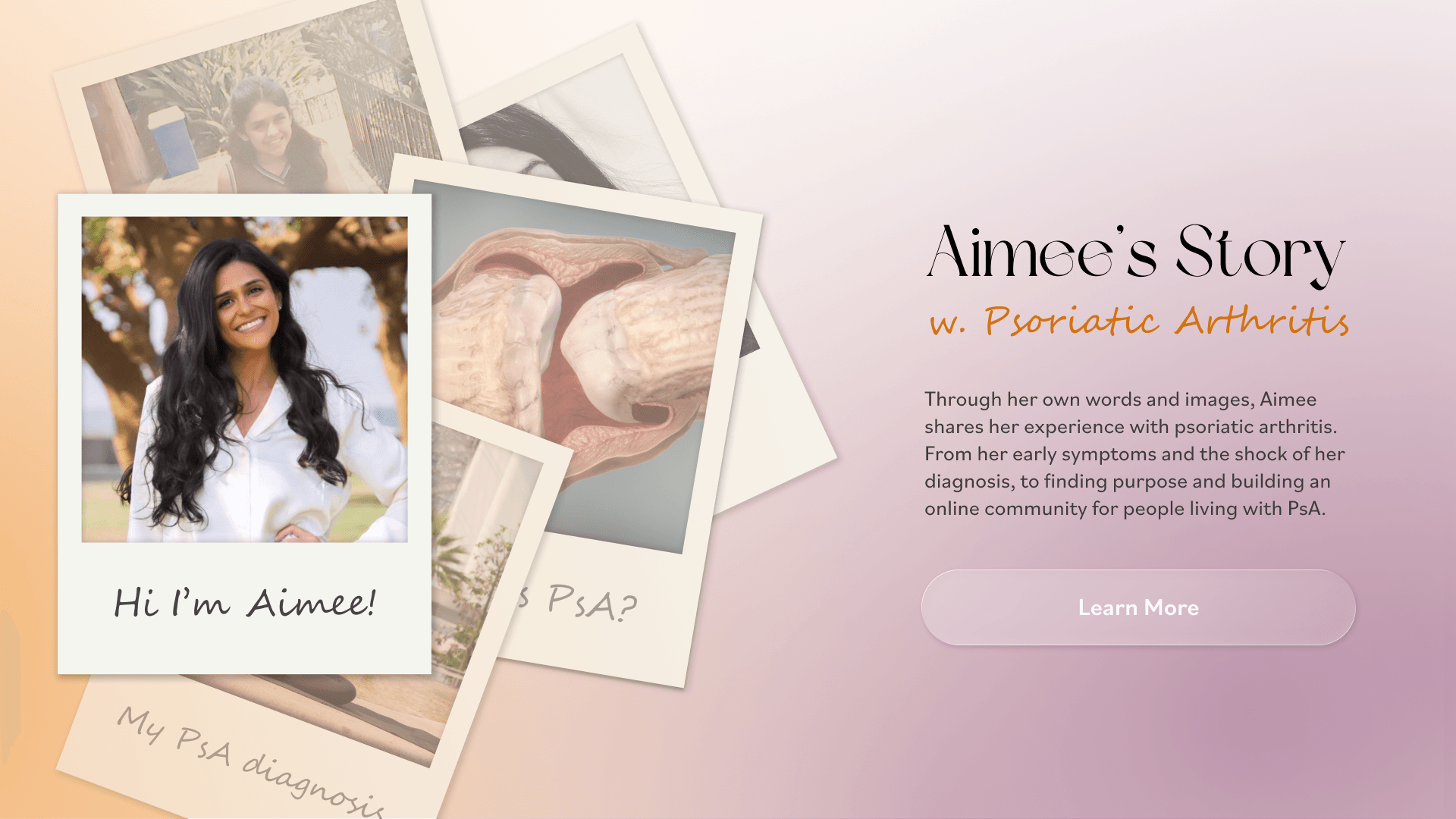 Interactive Patient Journey My Story - Psoriatic Arthritis