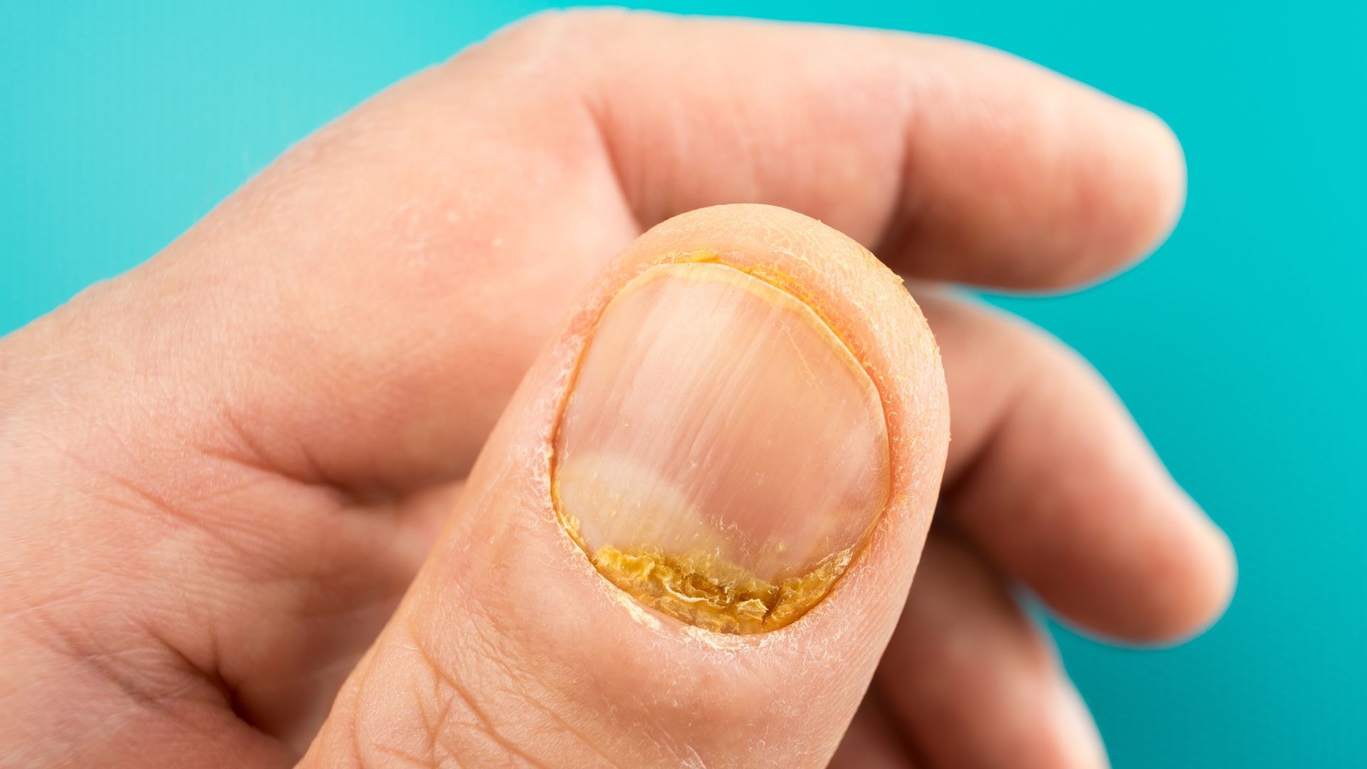 Can you have more than one type of psoriasis?