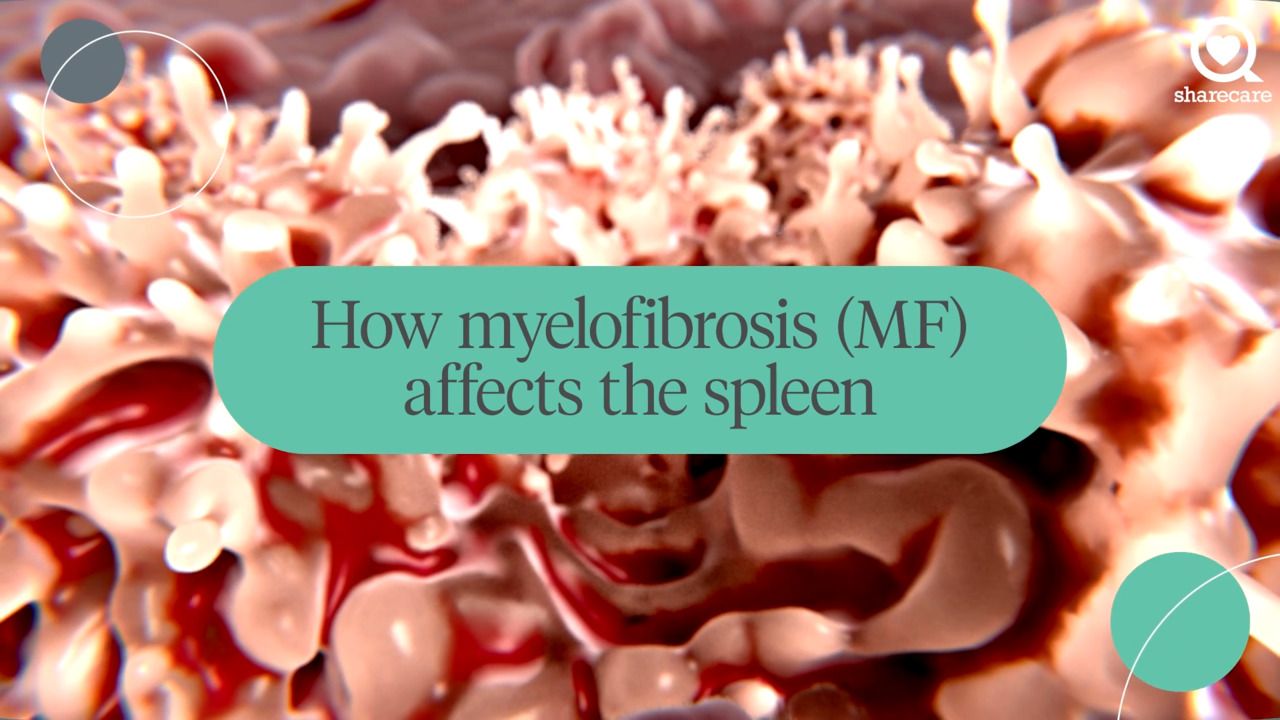 How myelofibrosis affects the spleen