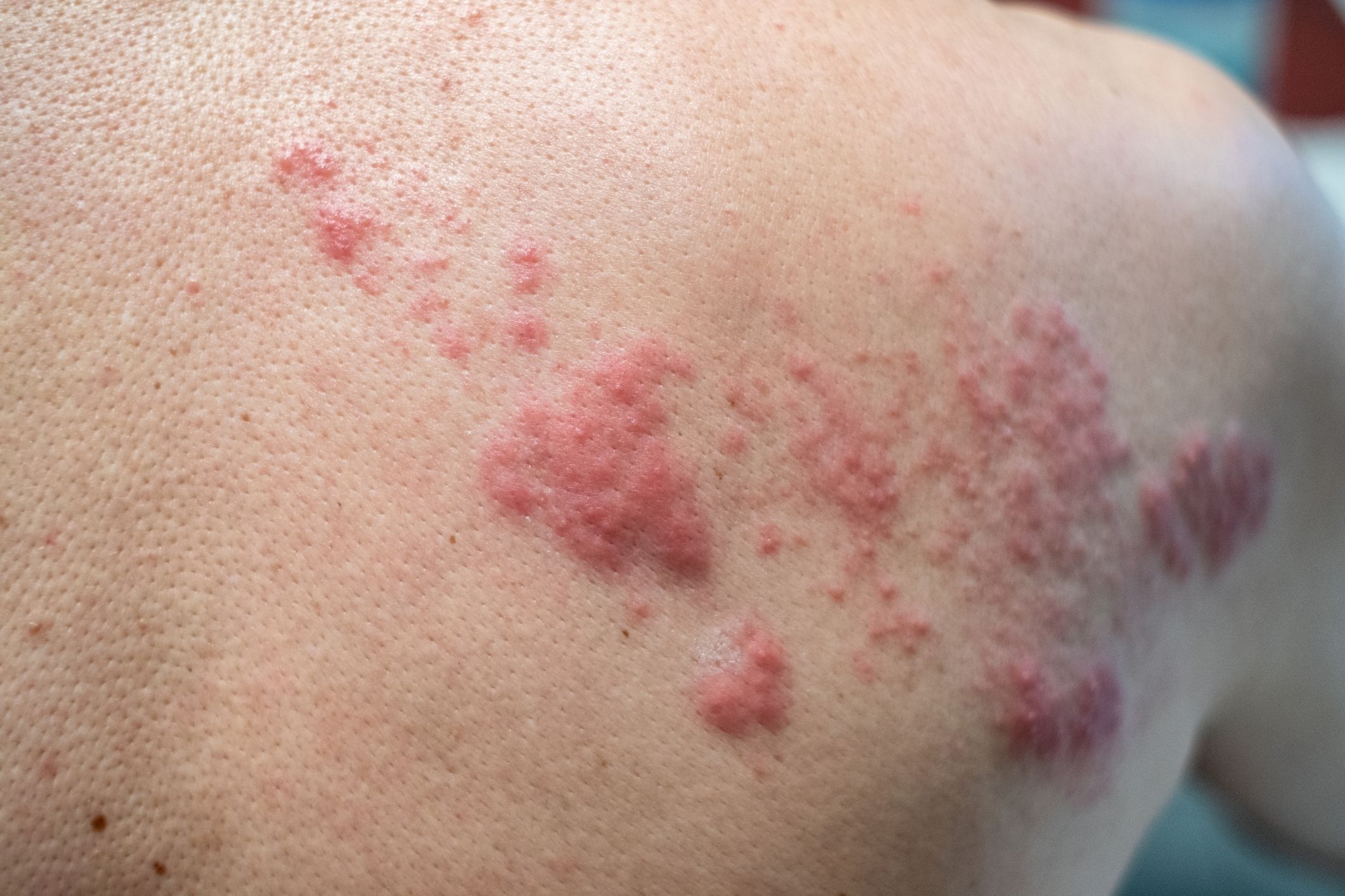 What to know about shingles