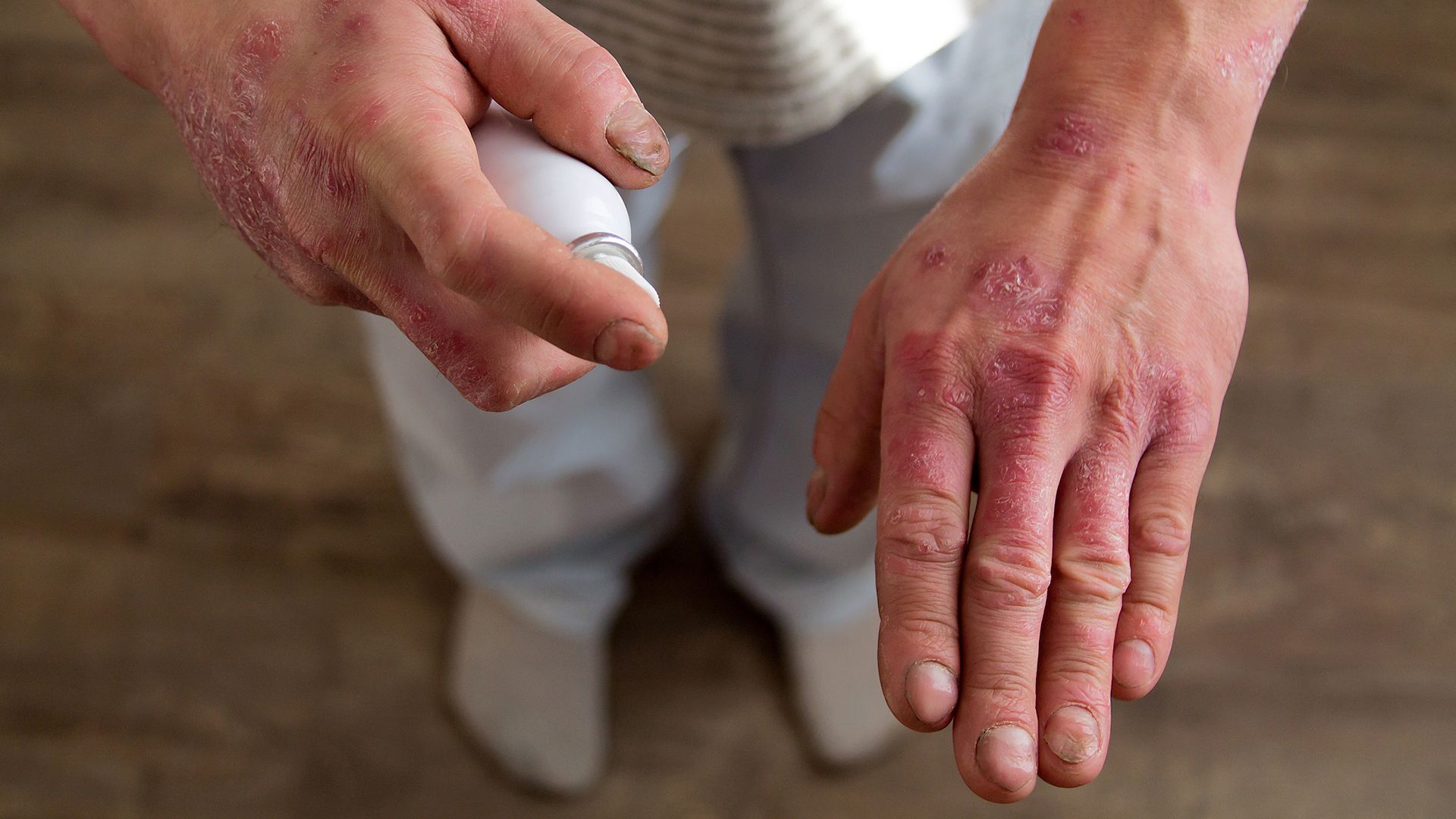 Is psoriasis mild, moderate, or severe?