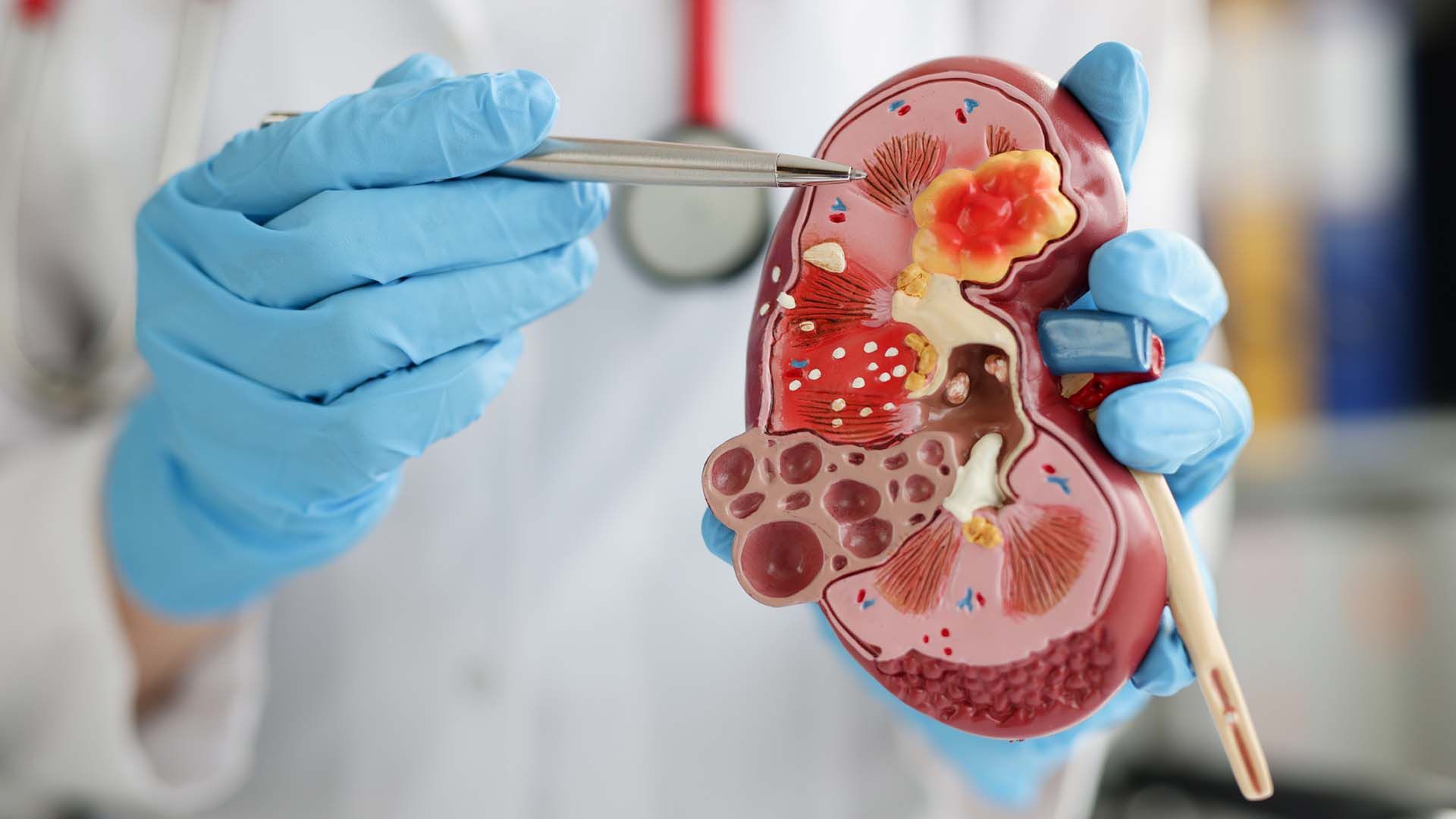 A quick guide to immunoglobulin A nephropathy (IgAN)
