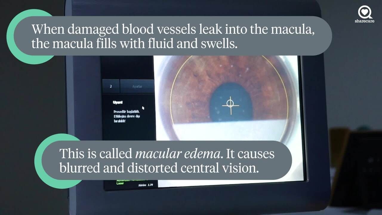 Understanding diabetic macular edema (DME)