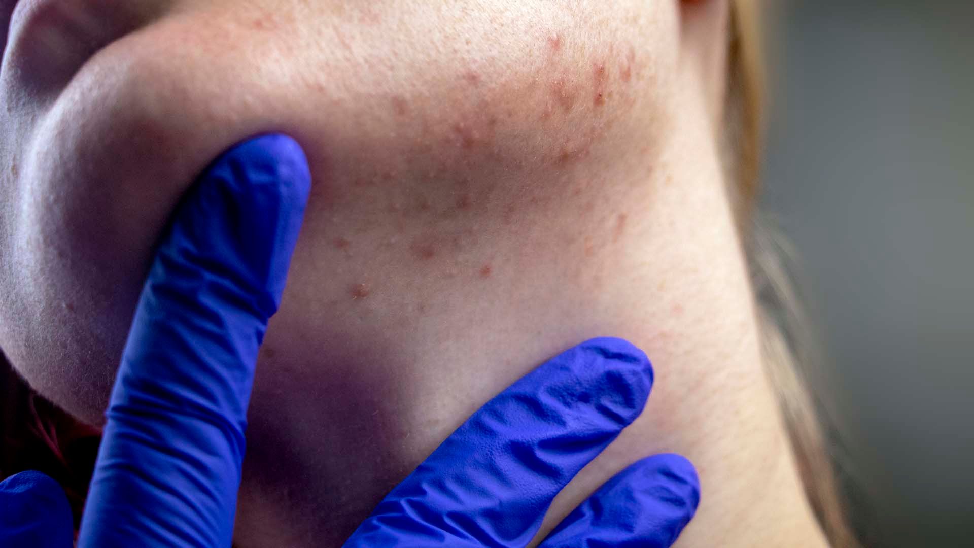 Understanding hormonal acne