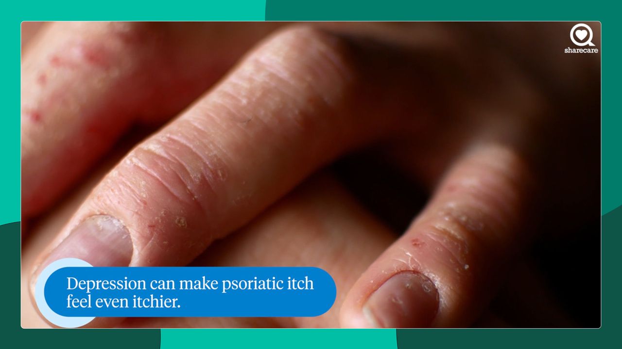 Mind your health: anxiety, depression, and psoriasis