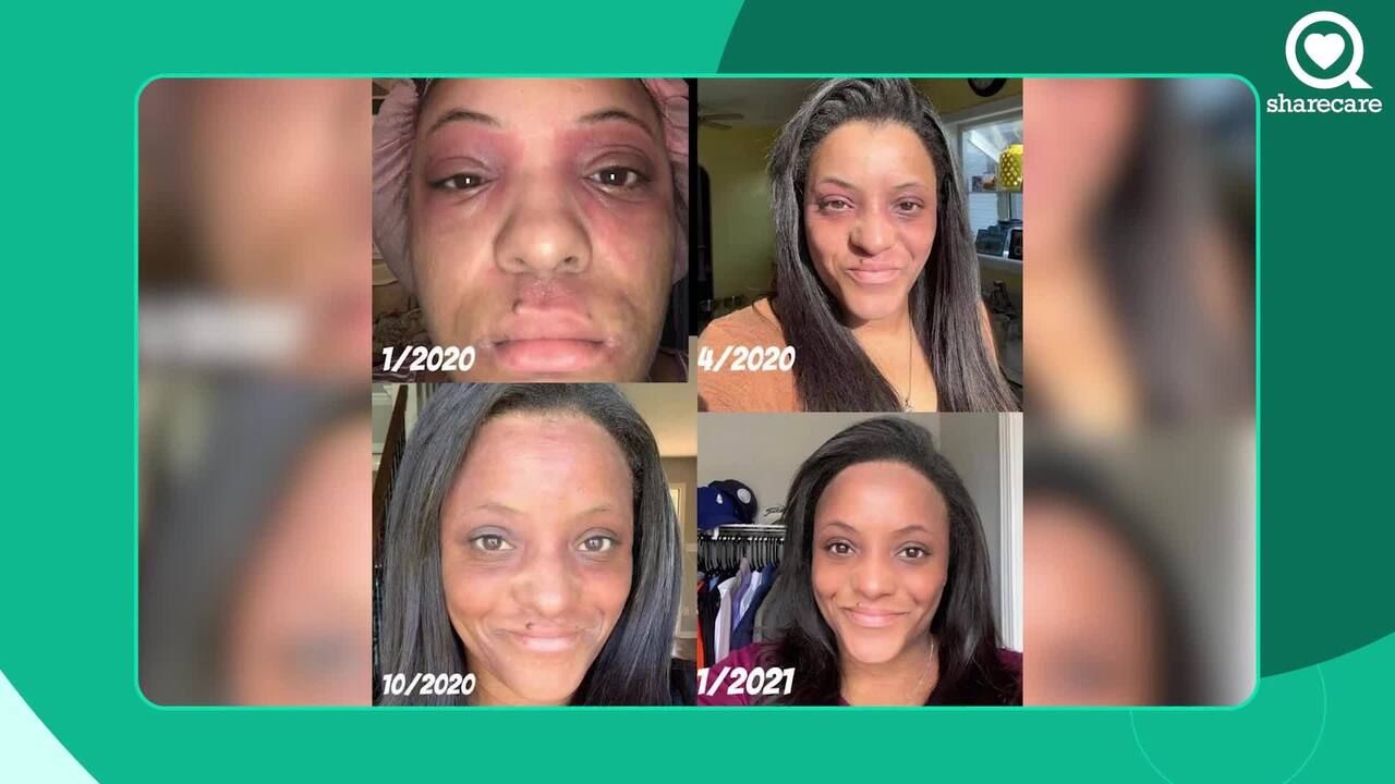 My confessional: Ashley S., atopic dermatitis