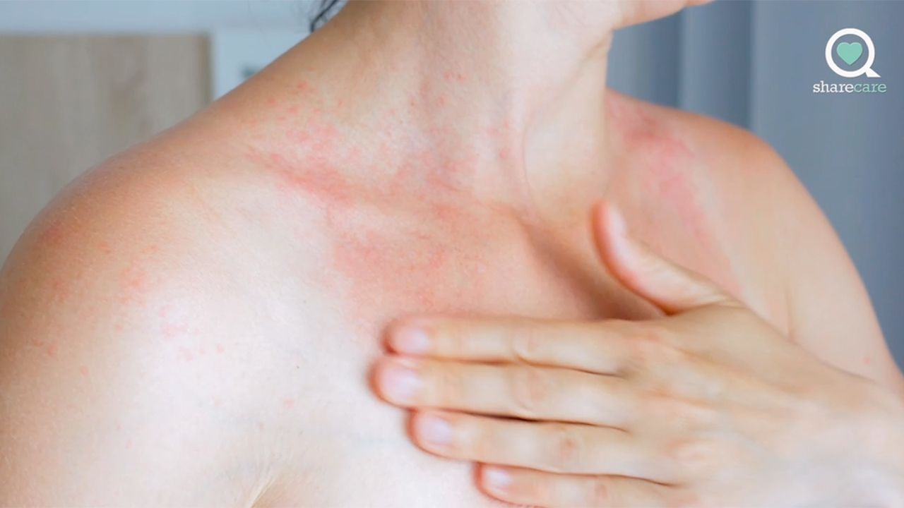 5 treatment options for chronic hives