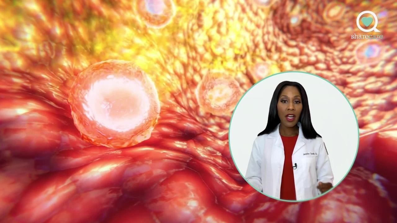 Virtual journey: chronic spontaneous urticaria