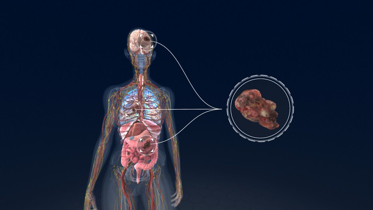 A virtual look at how lung cancer develops