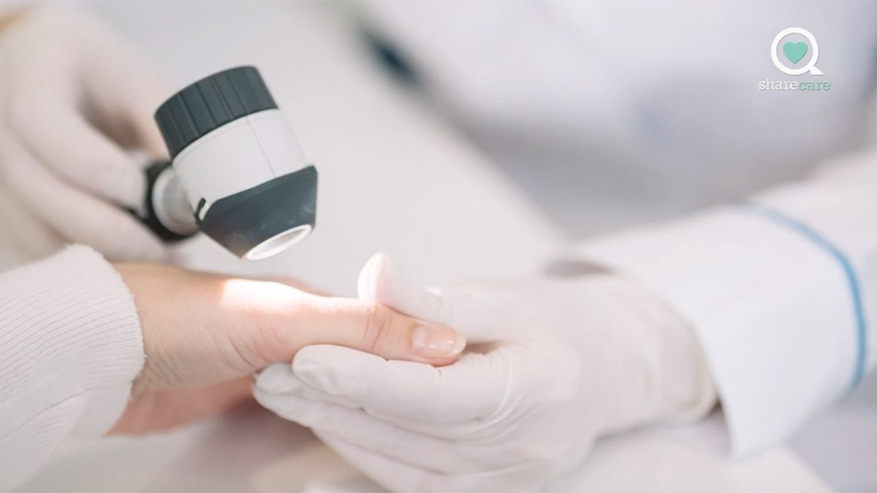 Understanding chronic hives